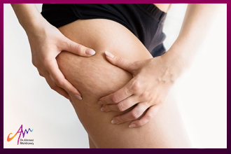 Cellulite and its causes